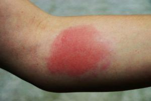 Wasp Sting Allergic Reaction